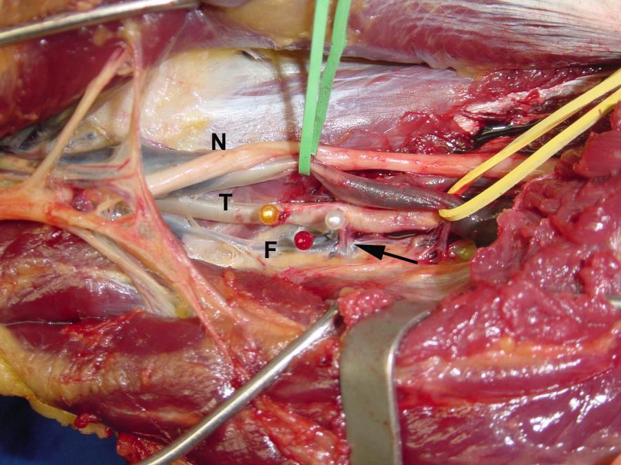 48 Figura 10. Detalhe da dissecção com identificação da a. fibular superior (seta). N N.