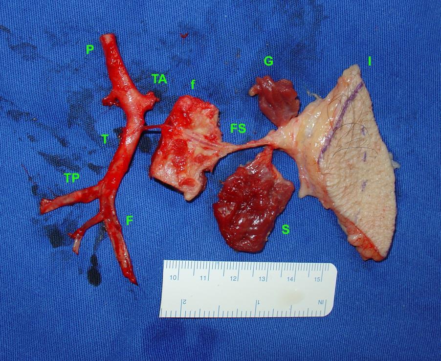 49 Figura 12. Visão panorâmica dos tecidos irrigados pela artéria fibular superior. P Artéria poplítea; TA A. tibial anterior; F A. fibular; TP A. tibial posterior; f Fíbula; FS A.