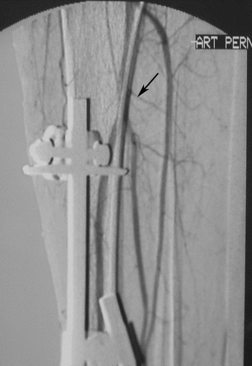 52 Figura 13. Aspecto arteriográfico com a artéria fibular superior se originando do tronco tíbio-fibular Figura 14.