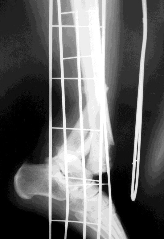 Caso 5 Aspecto radiográfico da fratura exposta do tornozelo (frente)