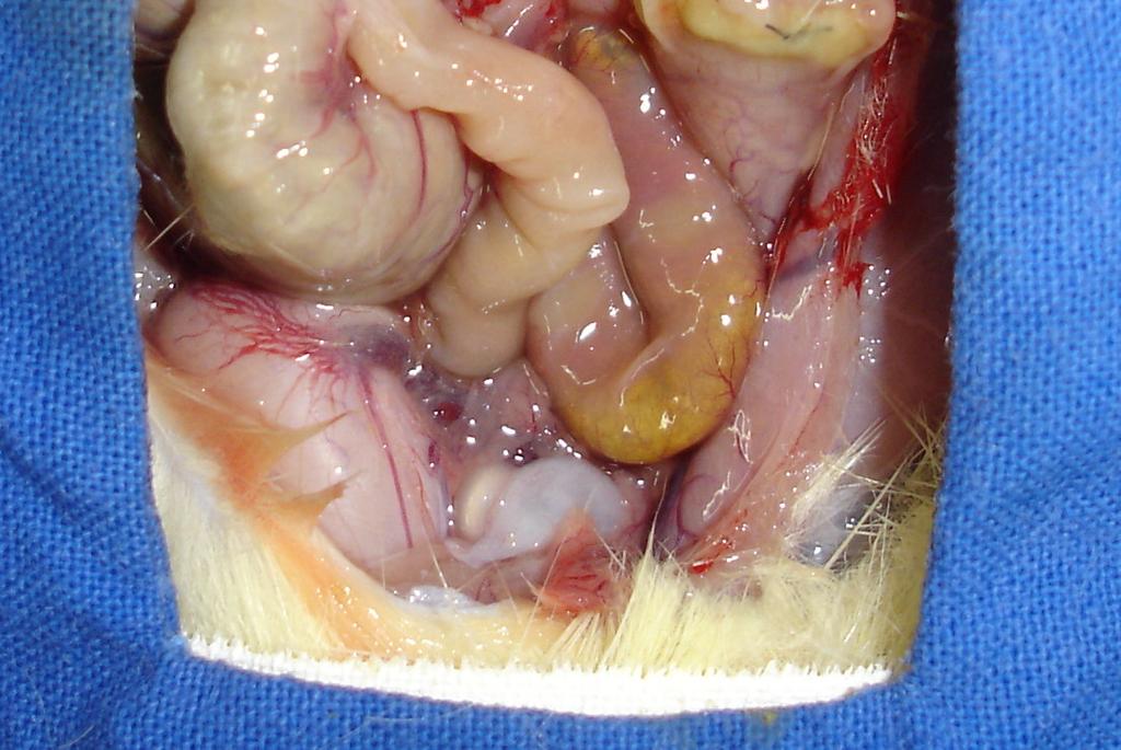 Na seqüência, após inspeção cuidadosa da cavidade, foi realizada a lise parcial das aderências e retirada de dois segmentos do cólon, de 5 cm de extensão cada, contendo a anastomose proximal e a