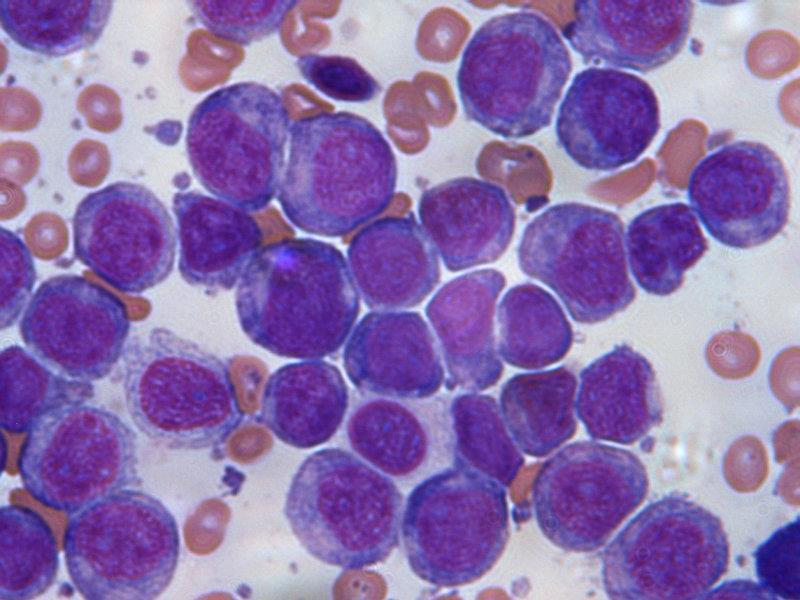 A Leucemia Aguda é dividida ainda de acordo com sua origem, podendo ser uma Leucemia