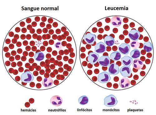 A leucemia linfocítica aguda (LLA), como o nome já diz, tem origem nos precursores dos