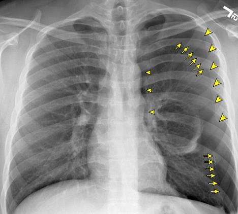 esquerdo do coração (cabeças de seta pequenas). A borda da escápula (cabeças de seta grandes) é muitas vezes confundida com um pneumotórax. Figura 1 Radiografia de tórax, incidência PA.