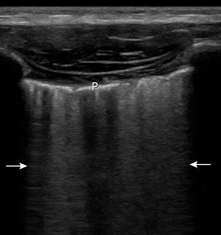 Figura 2 Ecografia de tórax apresentando o sinal da calda de cometa (setas) abaixo da pleura visceral (P) 6.