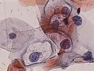 14 A Neoplasia Intra Epitelial Cervical grau 1 apresenta células escamosas superficiais com boa maturação.