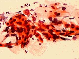 16 Carcinoma in situ e carcinoma metaplásico.