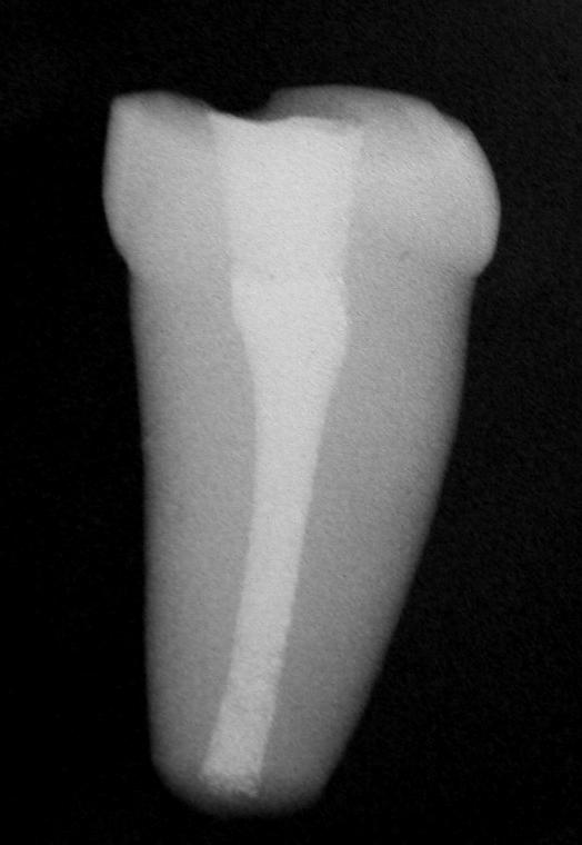 75 preenchimento da cavidade pelo material retroobturador (Figura 4.1). A B C Figura 4.1 - Radiografia dos espécimes após a retroobturação.