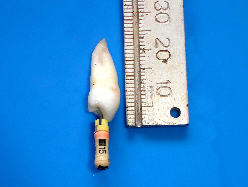 29 A odontometria foi realizada introduzindo-se uma lima do tipo Flexo-File n 15 no canal radicular até o momento em que sua guia de penetração atingisse o forame apical (Fotografia 3).