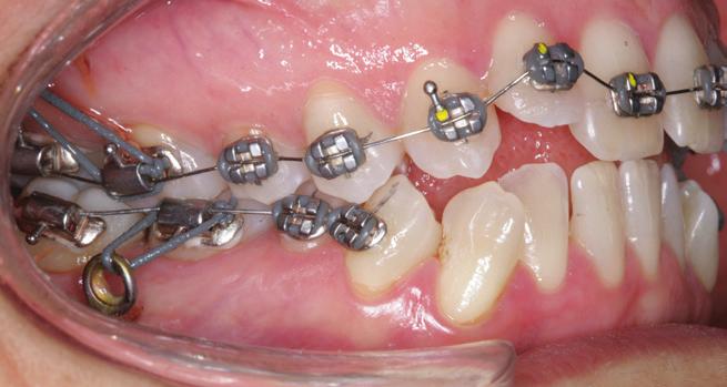 controlar a inclinação vestibular dos dentes pos- Nessa fase, foram instalados os miniparafusos