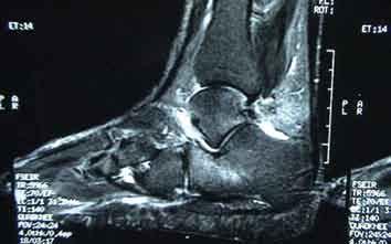 instabilidade do retropé (2). Primeiramente, foi descrita em 1958 como uma condição resultante de lesão ligamentar traumática do tornozelo (3).