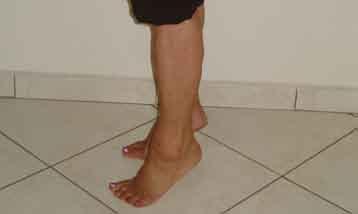 Seus achados artroscópicos incluíam lesões do ligamento talocalcaneal interósseo, instabilidade subtalar, lesões osteocondrais da articulação subtalar, coalisão tarsal fibrosa e alterações