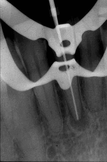 Se a imagem radiográfica nos mostra que a lima utilizada apresenta um erro por excesso ou mesmo por defeito de comprimento até ao ápice, devemos reajustar o stop e fazer uma nova radiografia.