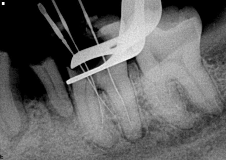 3 - Erros Inerentes à Instrumentação a) Perfurações As perfurações em endodontia são erros que podem ocorrer a qualquer momento do tratamento, sendo mais prevalentes durante a preparação e