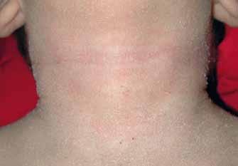 INTRODUÇÃO O eczema atópico é uma patologia inflamatória crónica, controlável, na maioria dos casos, apenas com tratamento tópico.