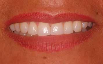 Figura 1a: Aspecto inicial do sorriso dentes não clareados.