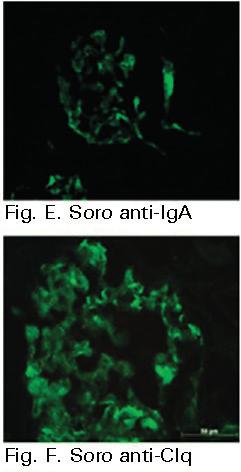 Figura 2. Imunofluorescência (IF). Soro anti-iga (Fig. E): positivo discreto a moderado mesangial nos glomérulos. Positivo em cilindros. Soro anti-igg: positivo discreto em alguns eixos mesangiais.