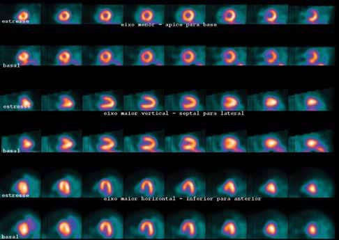 MÉTODOS DE AVALIAÇÃO DA PERFUSÃO MIOCÁRDICA Eixo menor - apice para base Eixo maior vertical - septal para lateral Eixo maior hotizontal - inferior para anterior Figura 1. Perfusão miocárdica normal.