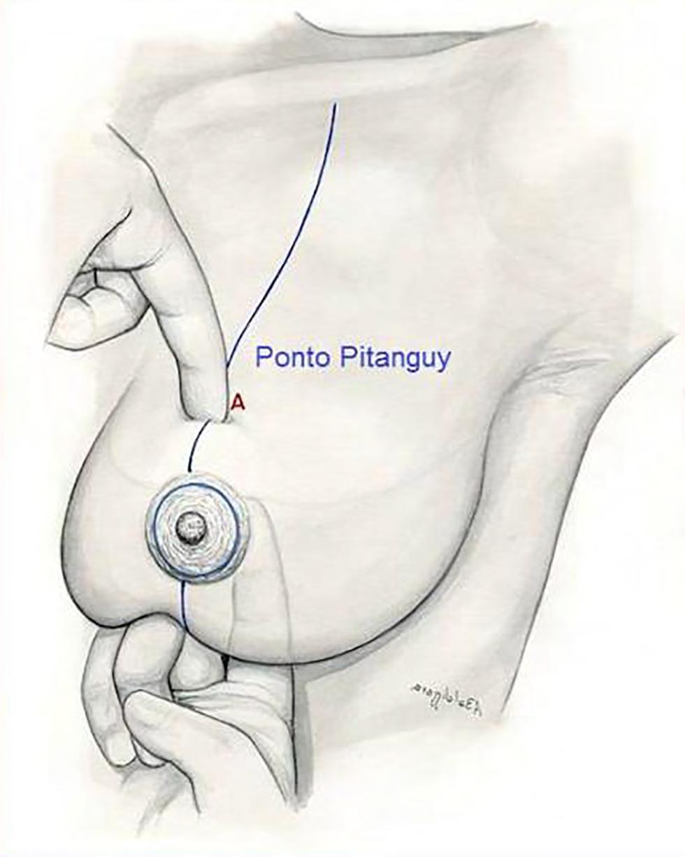 Mamoplastia redutora com realização de técnica de Pitanguy Figura 4. Marcação à Pitanguy-Marcação clássica de Pitanguy. Figura 2.