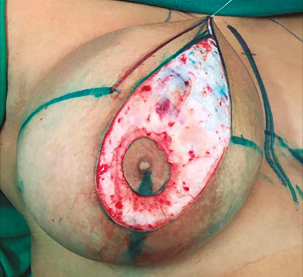 Houve dois casos de hipocromia em pequena área da margem areolar (Figura 16). DISCUSSÃO A mamoplastia redutora é uma das cirurgias mais comuns na prática do cirurgião plástico.