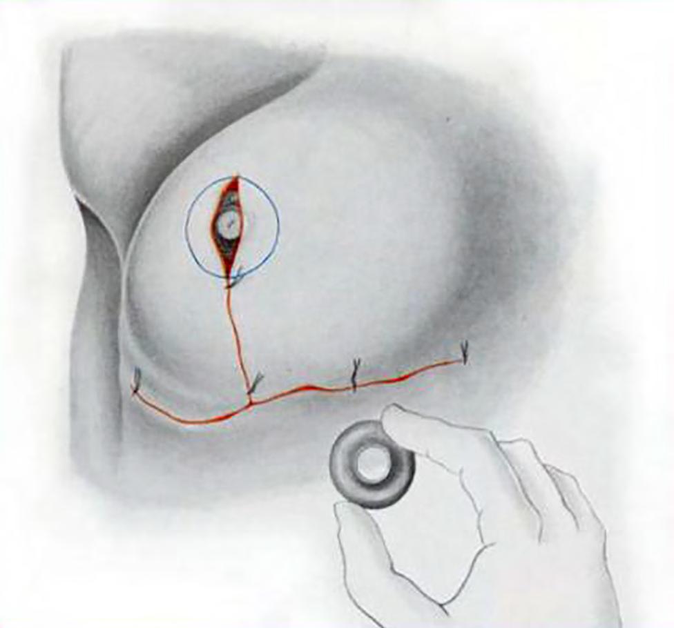 a vascularização da artéria mamária interna. A técnica se mostrou eficaz para o tratamento de casos de grandes hipertrofias, com o Figura 13.