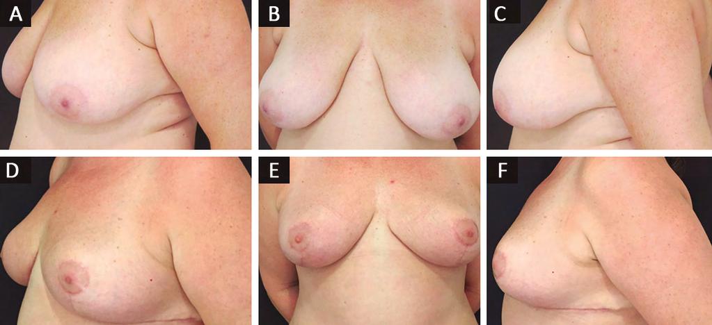 Gasparoni LAR et al. www.rbcp.org.br CONCLUSÃO Figura 14. A, B e C: Pré-operatório; D, E e F: Pós-operatório de 6 meses. Figura 15. A e B: Pré-operatório; C e D: Pós-operatório de 1 mês.