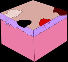 PROPEDÊUTICA DERMATOLÓGICA: LESÕES ELEMENTARES QUADRO 1: MÁCULAS E MANCHAS