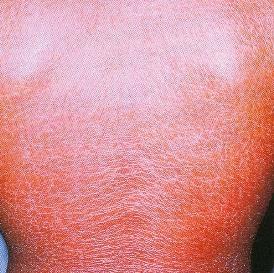 Rubeoliforme: máculas e pápulas puntiformes róseas (rubéola) entremeadas por pele normal;