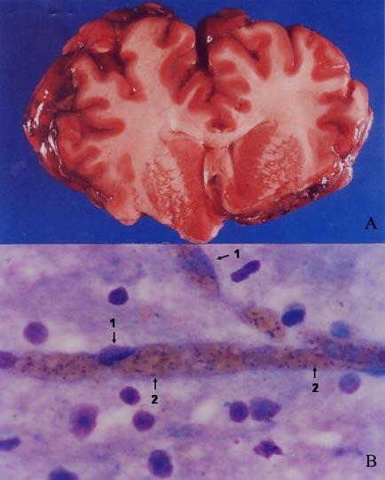 Babesiose cerebral em bovinos: 20 casos. 123 Figura 1 - Babesiose cerebral em bovinos causada por Babesia bovis (caso V-678-01). A.