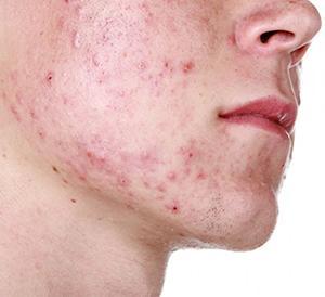 CAUSAS A acne aparece na puberdade induzida pelo início da produção de hormônios femininos (estrógenos) e masculinos (andrógenos).