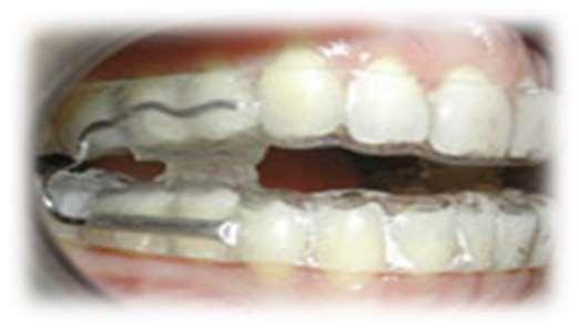 Airway Pressure); Aparelhos de