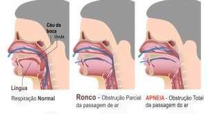 SÍNROME DA APNÉIA OBSTRUTIVA DO SONO E RONCO (SAOS) Caracterizada, segundo a Academia de Medicina do Sono, por episódios recorrentes de obstrução parcial ou total das Vias Aéreas Superiores (VAS);