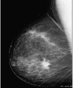 Capítulo 2 - Mamografia 18 Figura 2.