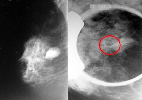 Capítulo 2 - Mamografia 20 (a) (b) Figura 2.11 Exemplos de mamografias(a) mamografia com presença de nódulo; (b) mamografia com agrupamento de microcalcificações 2.