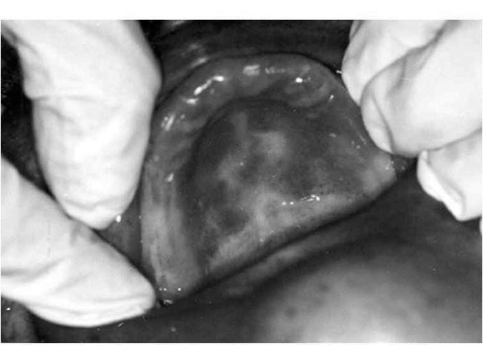 Atrófica crónica ou eritematosa crónica caracterizada por eritema e edema, geralmente localizado na parte