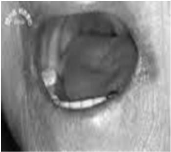 Queilite angular caracterizada por dor, eritema e fissuras nos cantos da boca, podendo ser erosiva ou granular. Por vezes há também infecção por Staphylococcus aureus.