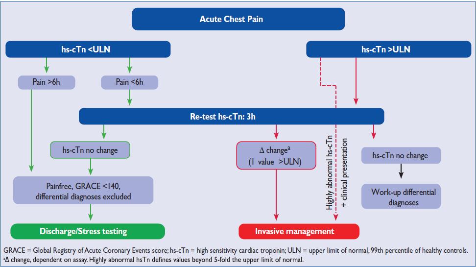 TROPONINA ULTRASSENSIVEL Hs Troponin: CV of 10% or less at the 99th percentile of normal healthy individuals, and the