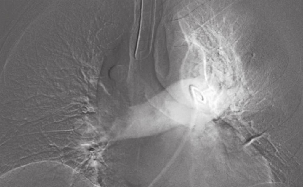 Figura 1. rteriografia pulmonar identificando falha de enchimento no tronco da pulmonar bilateralmente, com preservação da opacificação pelo meio de contraste apenas no segmento apicoposterior.