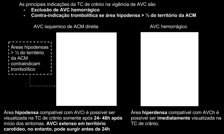 NEUROIMAGEM É de extrema importância no AVC, seja com tomografia computadorizada ou ressonância magnética de crânio, principalmente nas sequências diffusionweighted imaging (DWI) e apparent diffusion