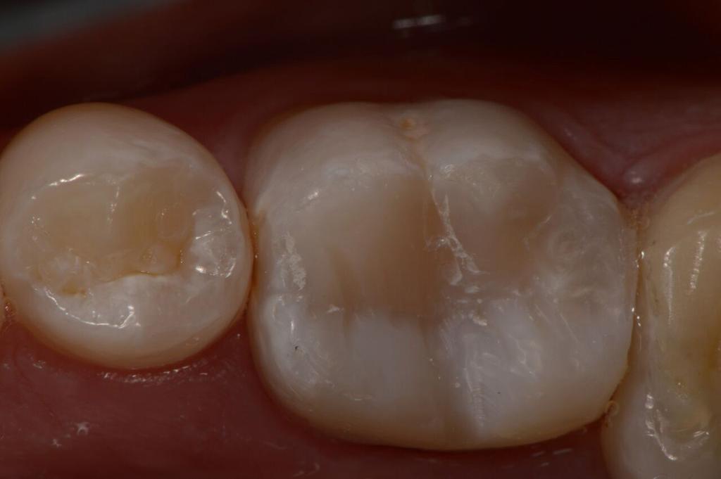 Figura 4A, 4B. Aspectos clínico (A) e radiográfico final(b) após 6 meses Odontol UNESP. 2010; 39(1): 49-54. 5. Schmitt D, Bogen G. Multifaceted use of ProRoot MTA root canal repair material.