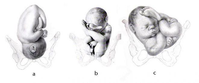 e) o ombro fetal apresenta-se próximo à pelve materna. COMENTÁRIOS: Tipos de apresentação fetal: a. Cefálica: cabeça fetal aproxima-se da pelve materna; b.