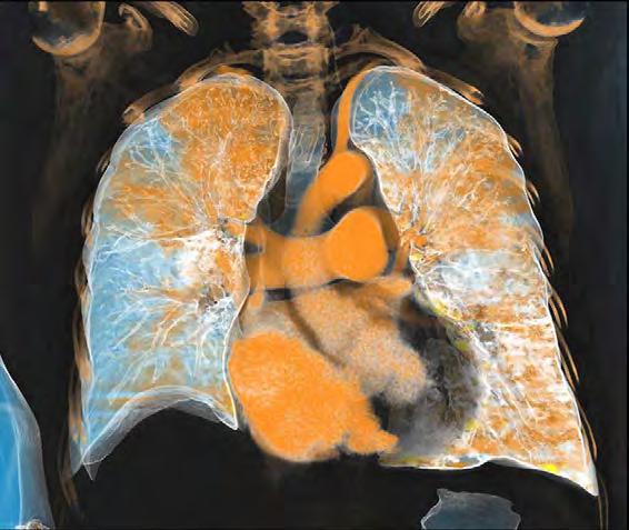 Diagnóstico de Embolia Pulmonar A