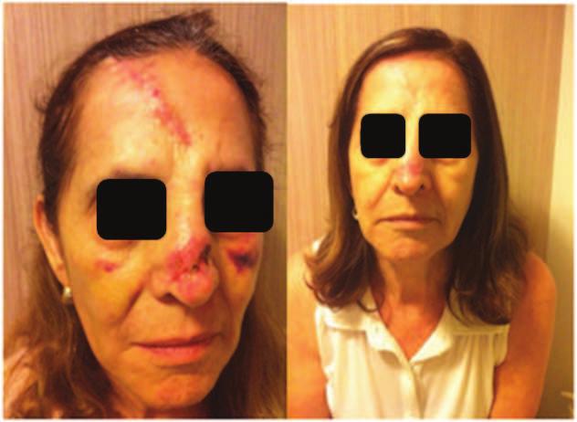 Paciente 2 Paciente do sexo feminino, 68 anos, com recidiva de carcinoma espinocelular em conjuntiva bulbar,