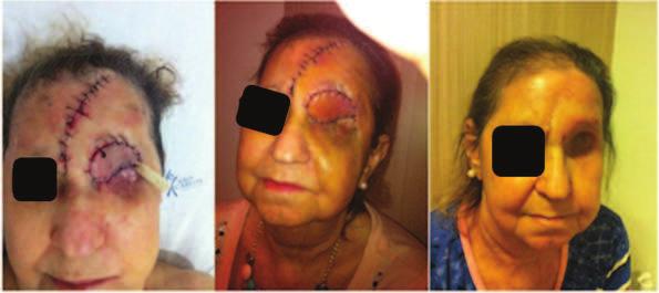 Paciente 3 Paciente do sexo feminino, 81 anos, com lesão em médio dorso nasal.