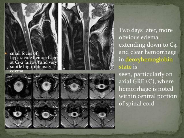 Trauma cervical com