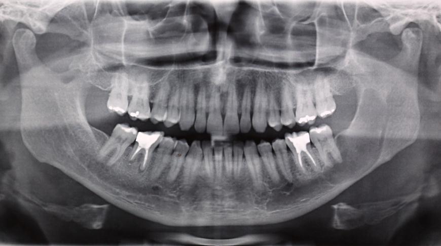 periósteo e com fenestração da cortical óssea. O acesso foi ampliado de forma circular, por meio de osteotomia com broca sob irrigação abundante.