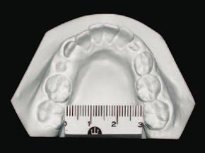a obtenção de espaço para a correção de apinhamento dentário, a correção axial dos dentes posteriores, a melhora na estética do sorriso e o auxílio no tratamento de pacientes Classe II.