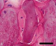 1) Os espécimes de biópsia muscular revelaram inúmeros vacúolos subsarcolemais e centrais em coloração com hematoxilina-eosina (a) com ácido-schiff periódico (B) e siríus vermelho (C), vacúolos