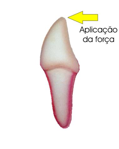 óssea na região pressionada - deposição óssea na região tracionada Fisiologia: Movimento patológico: -necrose da região pressionada -não deposição óssea na região tracionada Área pressionada