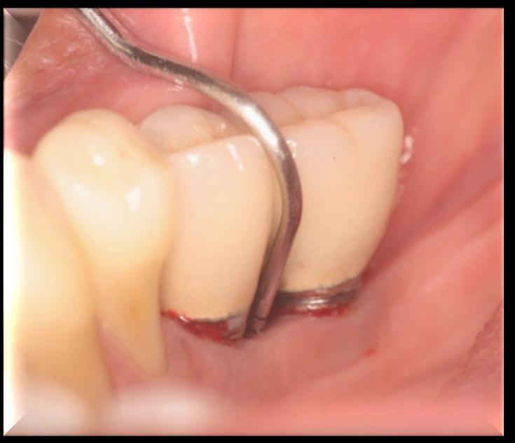 gengiva/mucosa ao fundo da bolsa ou sulco peri-implantar ou periodontal realizada em 6 sítios ao redor dos dentes e dos implantes (mesiovestibular, médiovestibular, distovestibular, mesiolingual,